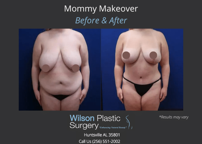 Before and after image showing a Mommy Makeover.