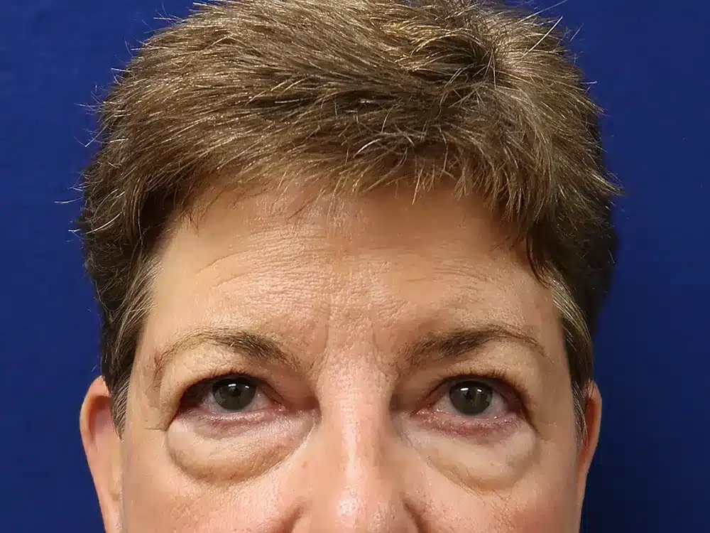 blepharoplasty patient before