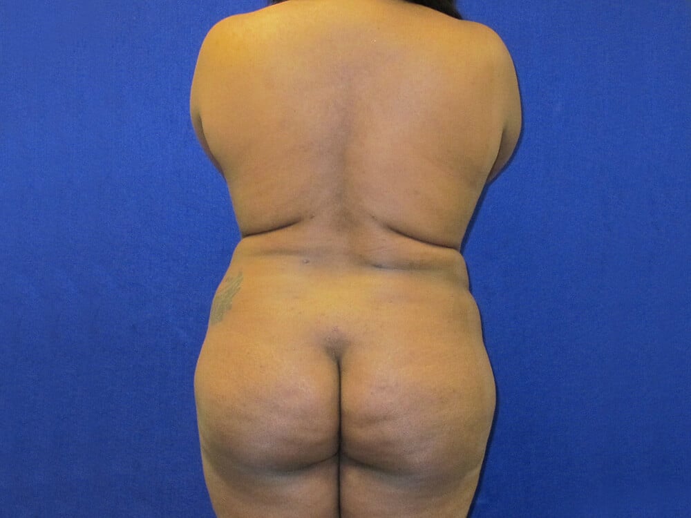 Case--7855 | Before Fat Grafting