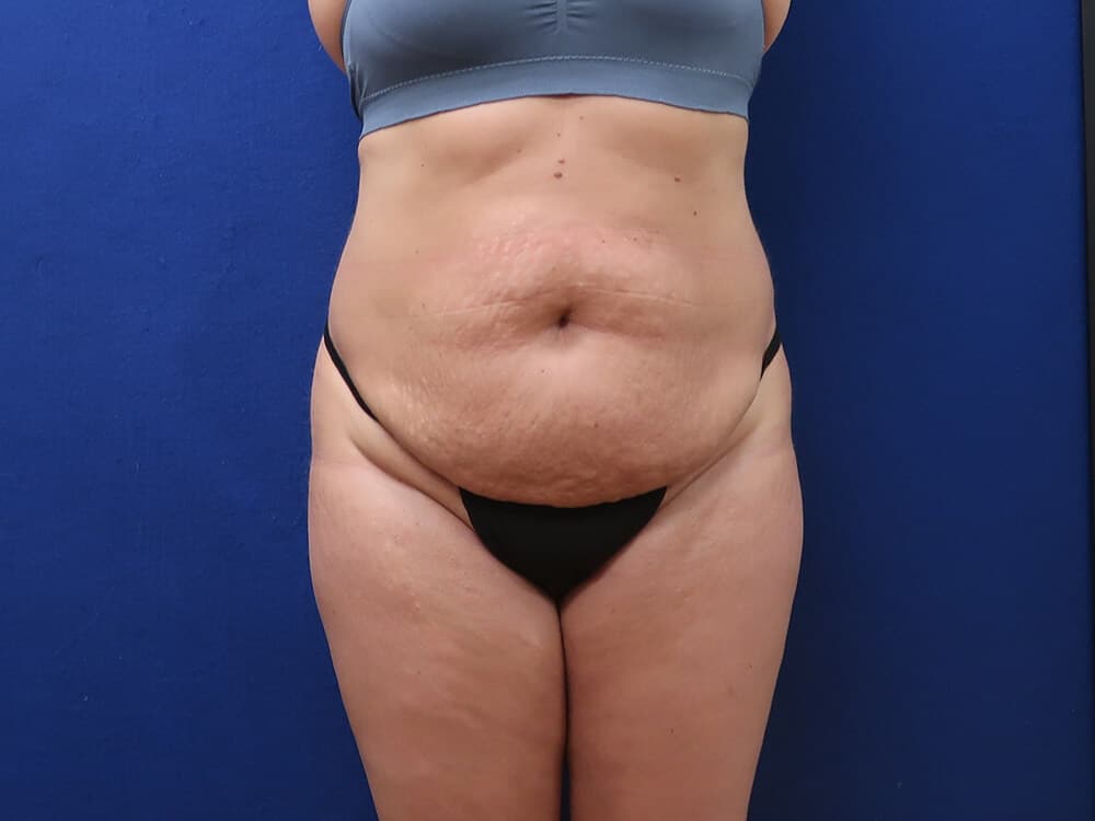 Case--8498 | Before Body