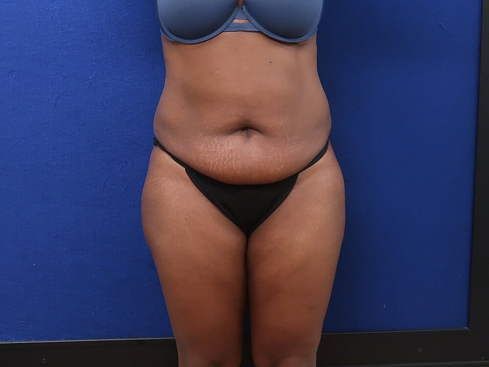 Case--6121 | Before Body