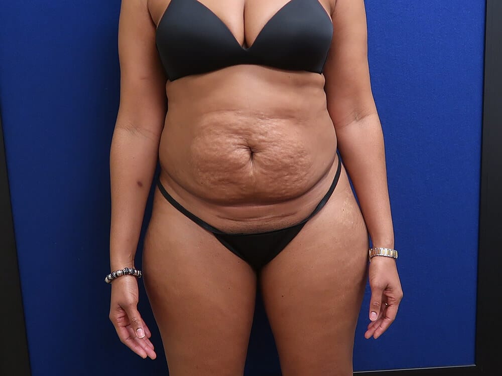 Case--2303 | Before Tummy Tuck