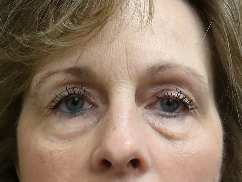 Case--7561 | Before Injectables