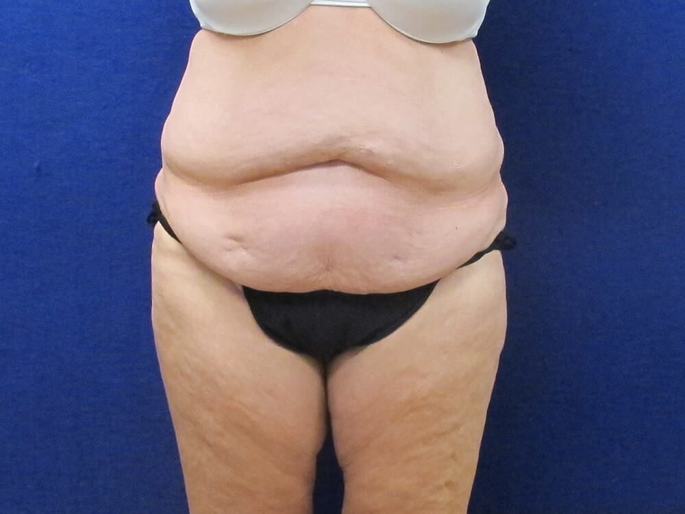 Case--9526 | Before Lower Body Lift