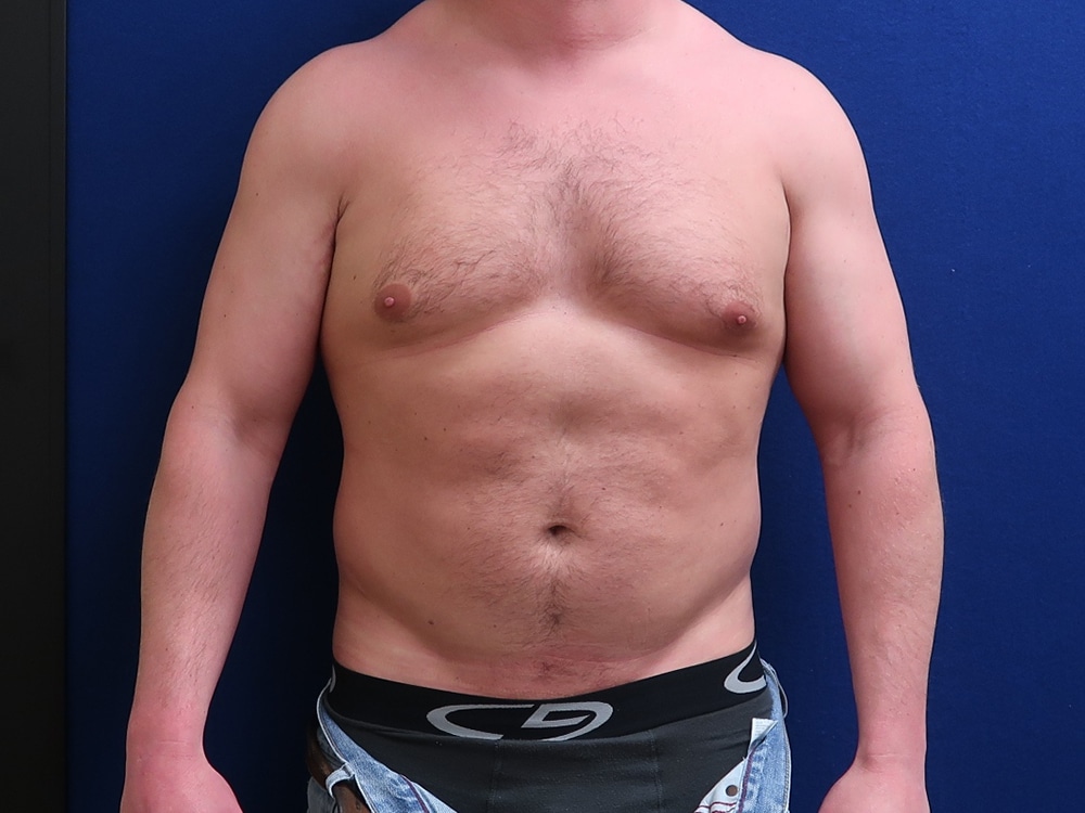 Case--1628 | Before High Definition Liposuction