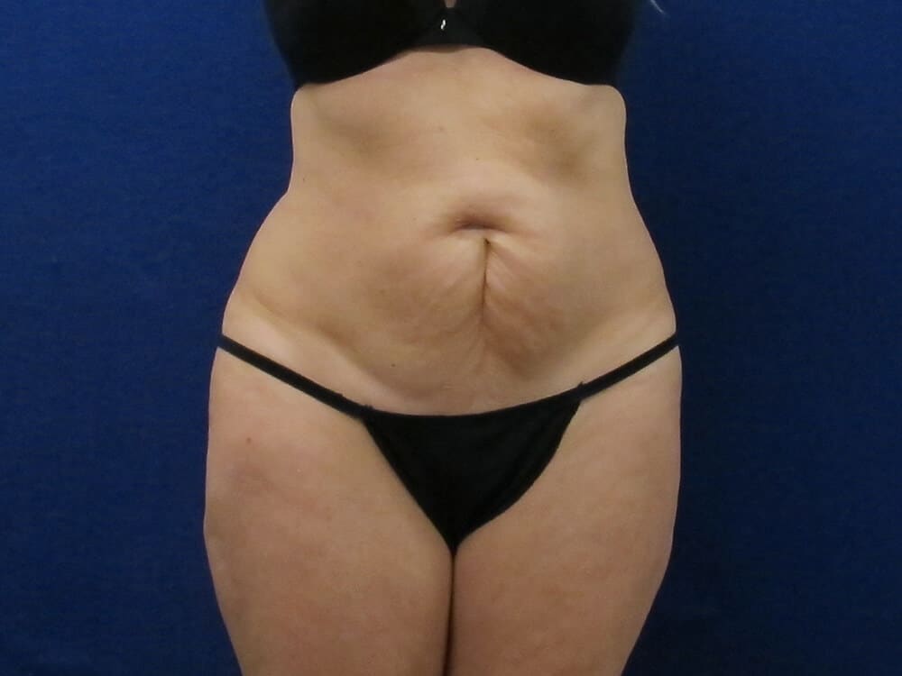 Case--5083 | Before Tummy Tuck