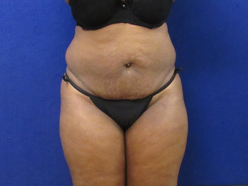 Case--9052 | Before Tummy Tuck