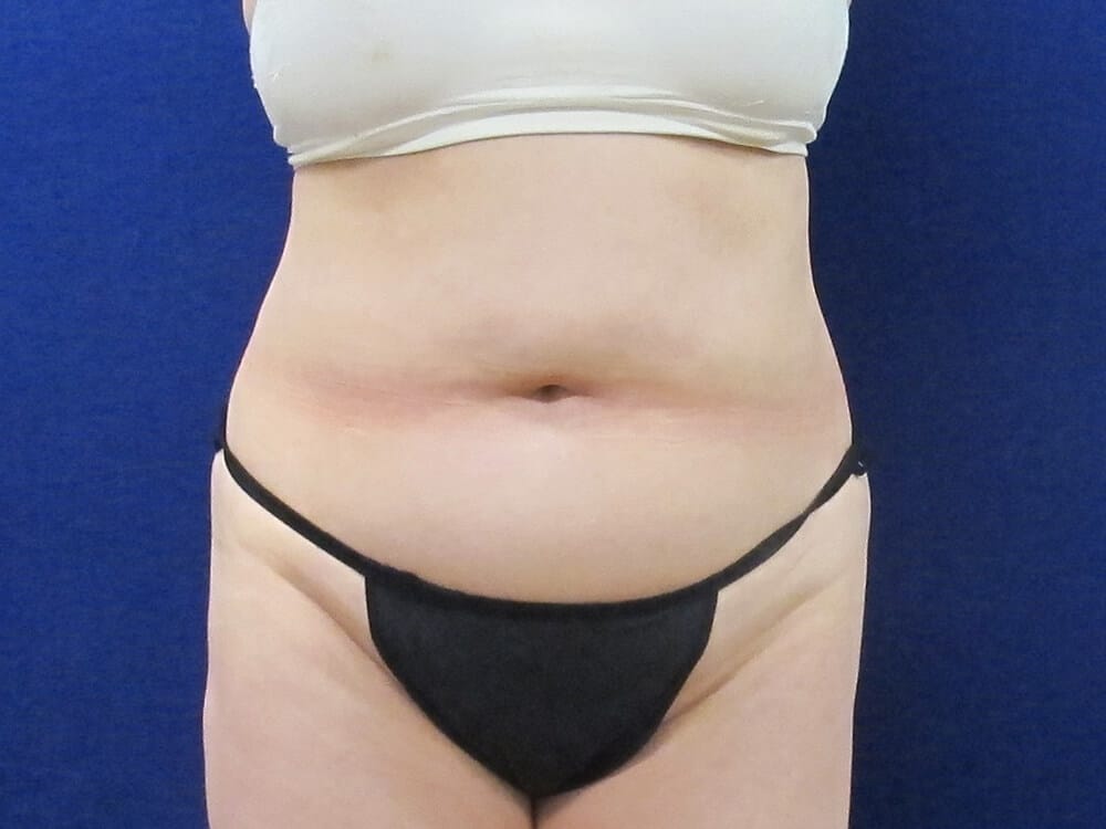Case--5359 | Before Liposuction