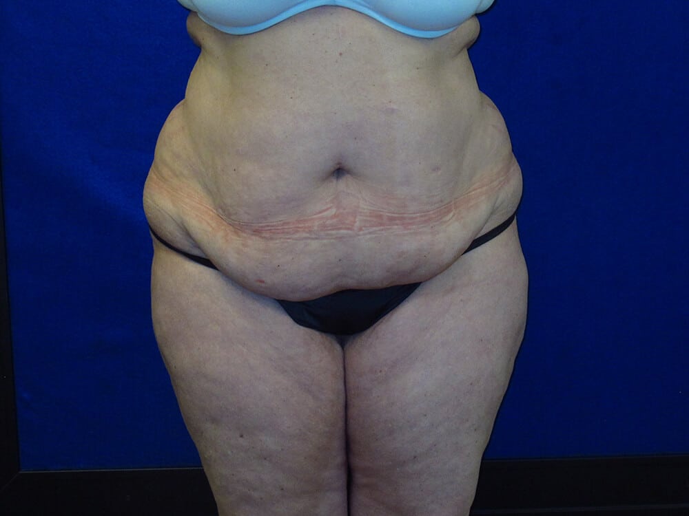 Case--1199 | Before Tummy Tuck