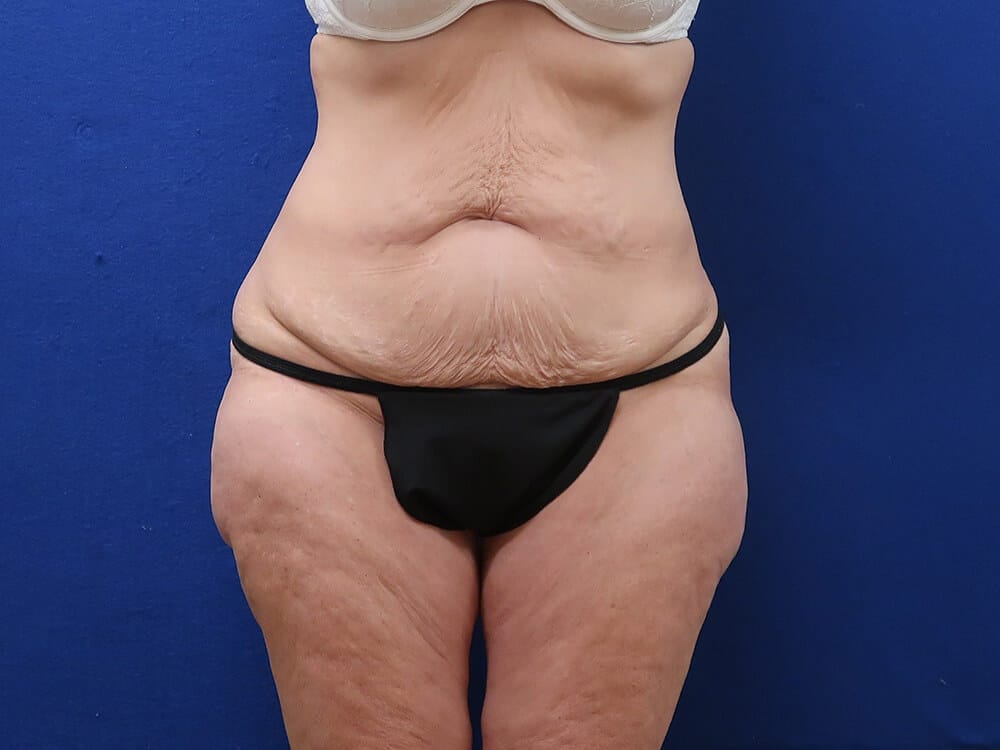 Case--8158 | Before Lower Body Lift