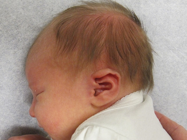 Case--9898 | Before EarWell™