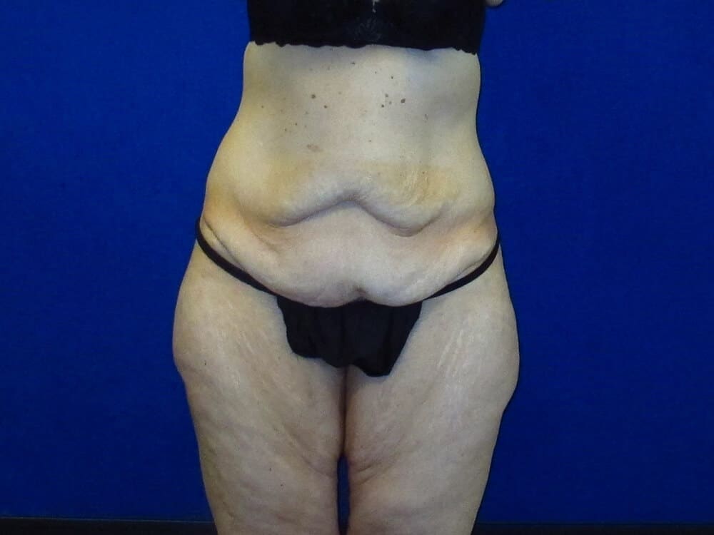 Case--7252 | Before Lower Body Lift