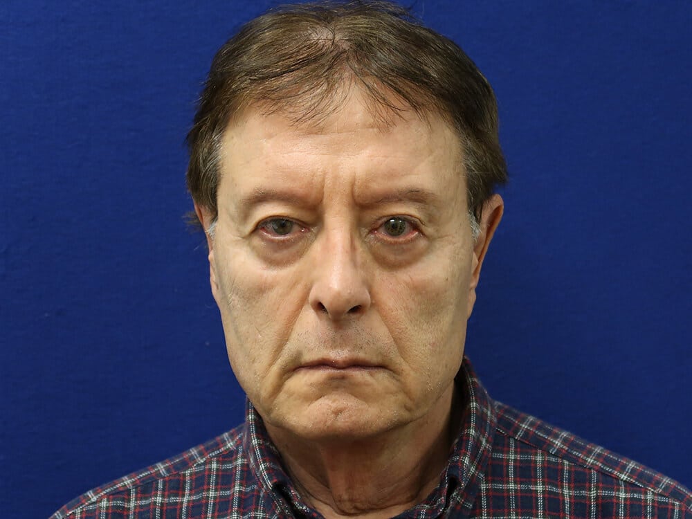 Case--1963 | Before Facelift