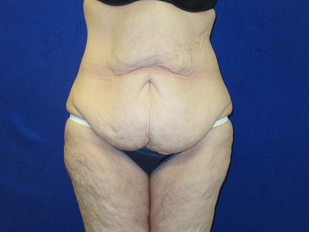 Case--3737 | Before Body