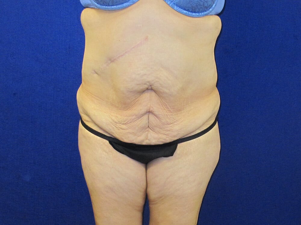Case--9062 | Before Tummy Tuck