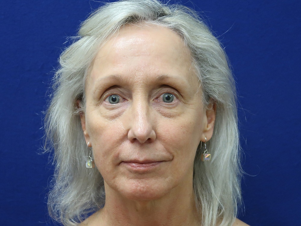 Case--9539 | Before Injectables