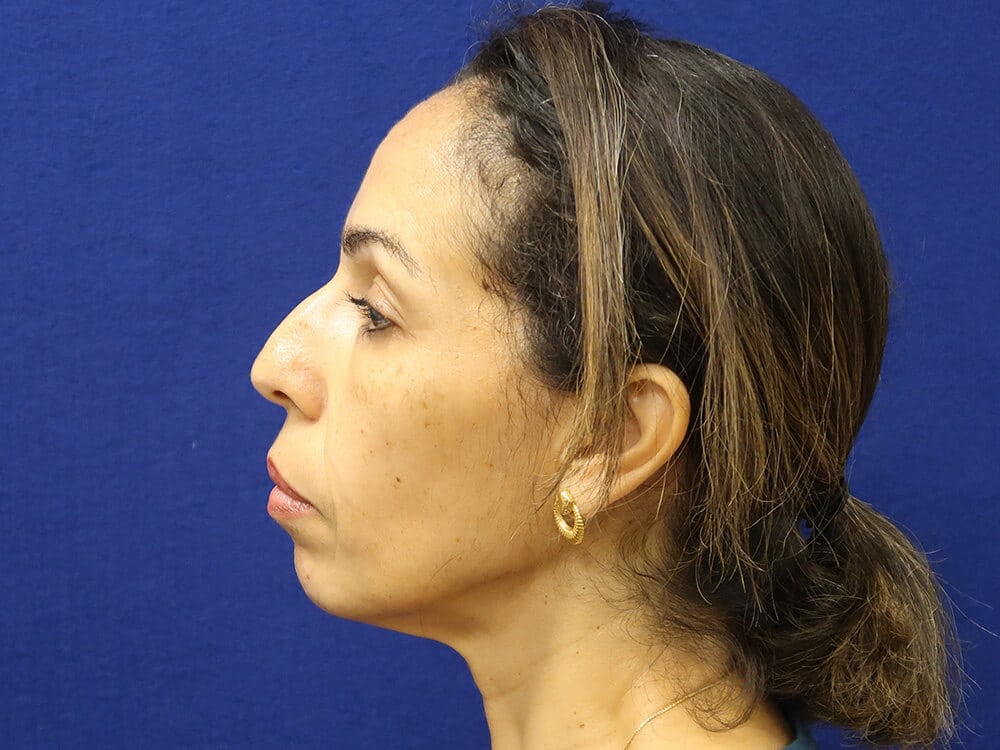 Case--6912 | Before Injectables