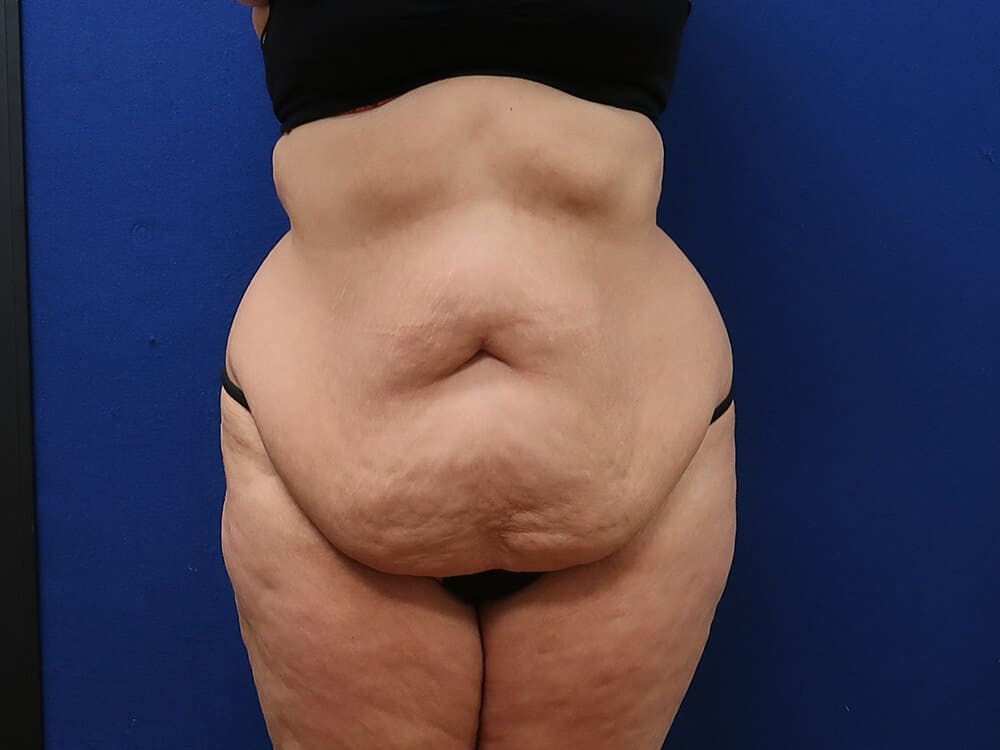 Case--3214 | Before Tummy Tuck