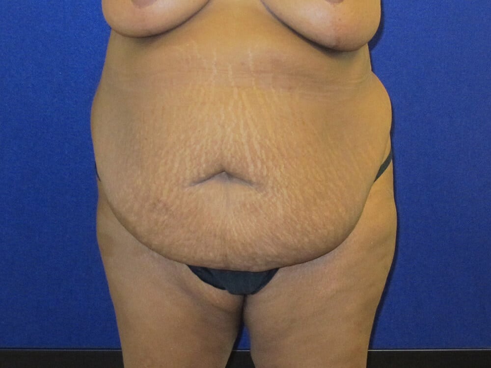 Case--8638 | Before Tummy Tuck