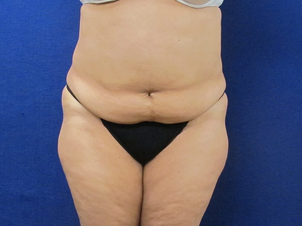 Case--4955 | Before Tummy Tuck