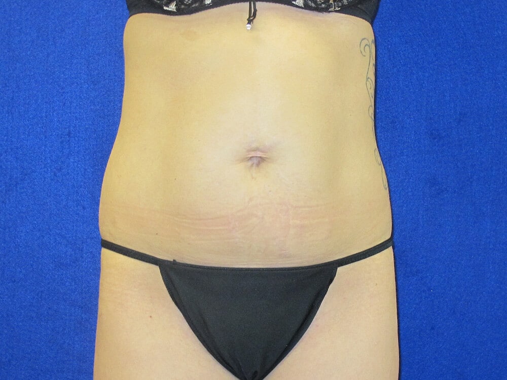 Case--5481 | Before Tummy Tuck