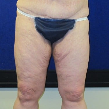 Thigh Lift - Before