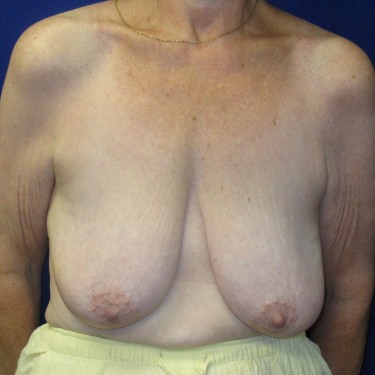 Breast Reconstruction - Before