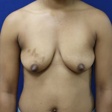 Breast Augmentation with Lift - Before