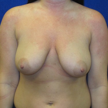 Breast Augmentation with Lift - Before