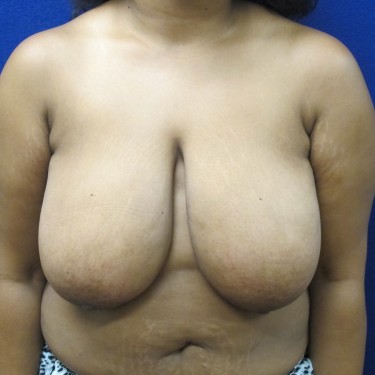 Breast Reduction - Before