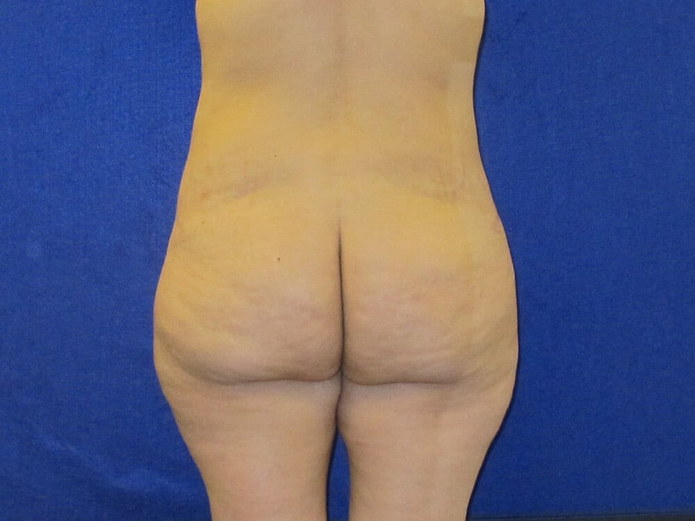 Case--7829 | Before Fat Grafting