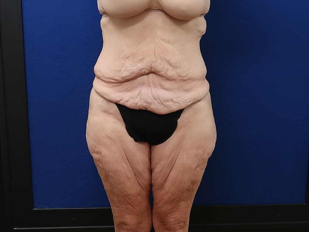 Case--9018 | Before Lower Body Lift