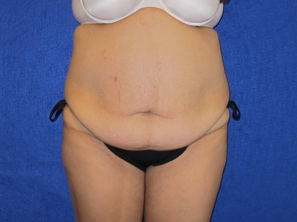 Case--4412 | Before Tummy Tuck