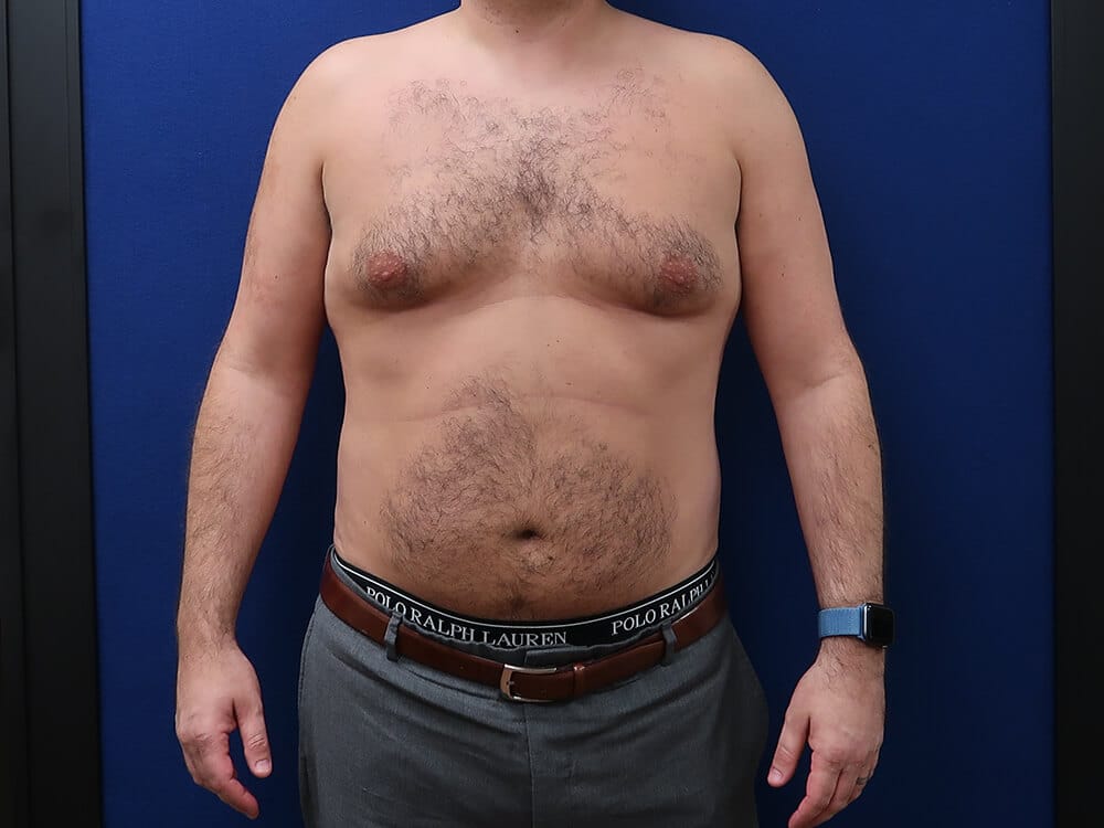 Before Male Breast Reduction Gynecomastia