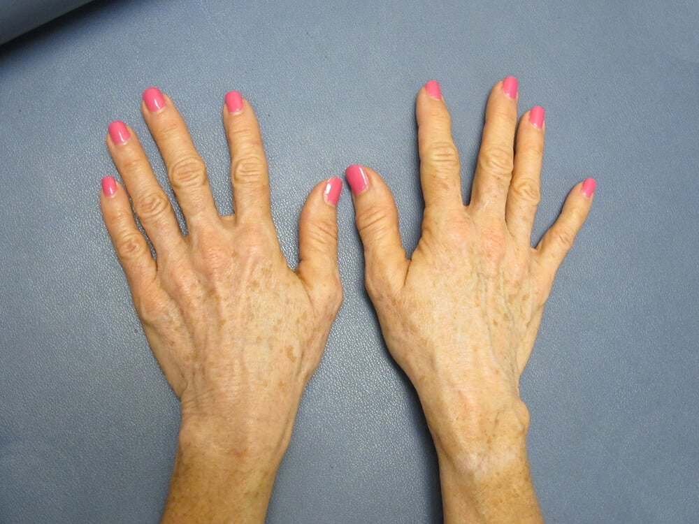 Case--9825 | Before Fat Grafting