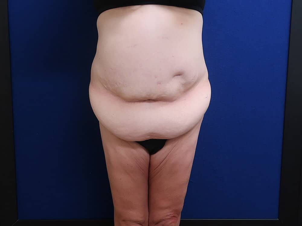 Case--7495 | Before Lower Body Lift