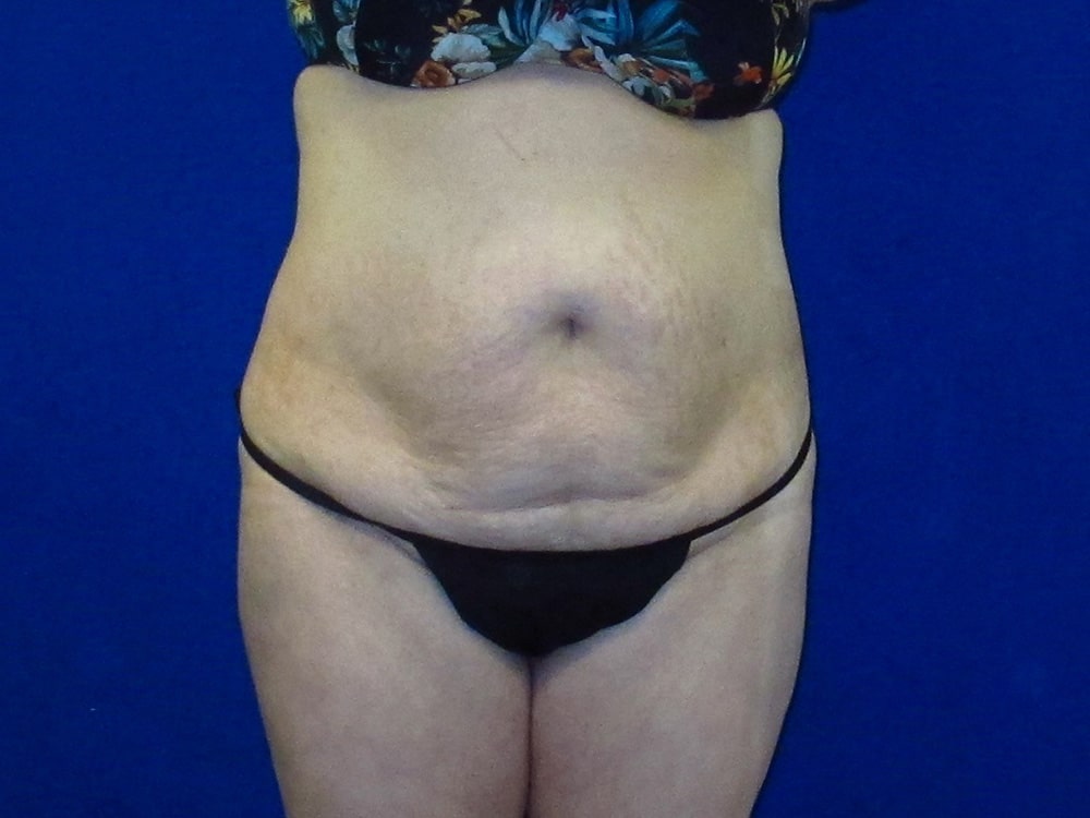 Case--9340 | Before Tummy Tuck