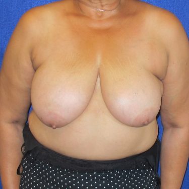Breast Reduction - Before