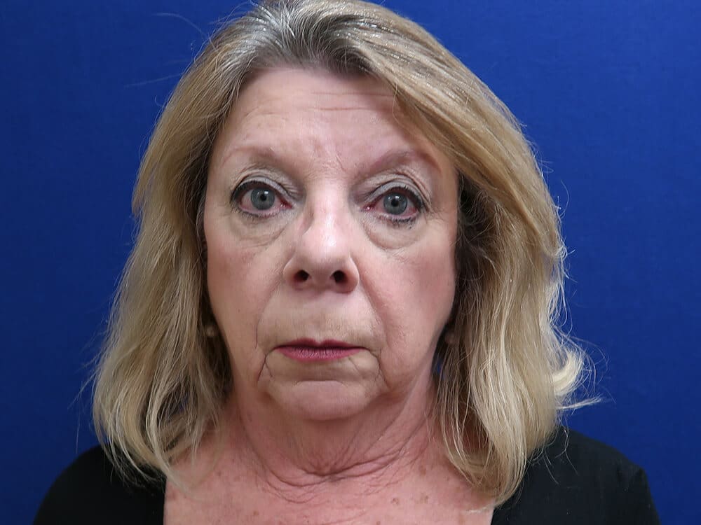 Case--4847 | Before Facelift