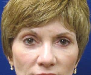 Case--3690 | After Blepharoplasty