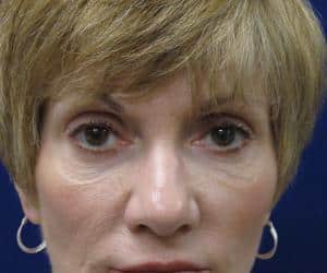 Case--3690 | Before Blepharoplasty