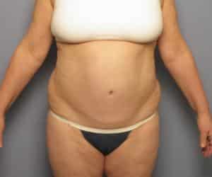 Case--4283 | Before Liposuction