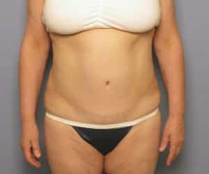 Case--4283 | After Liposuction