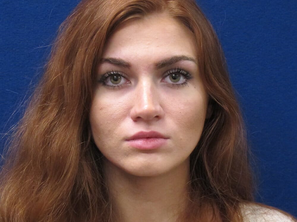 Case--7286 | Before Injectables