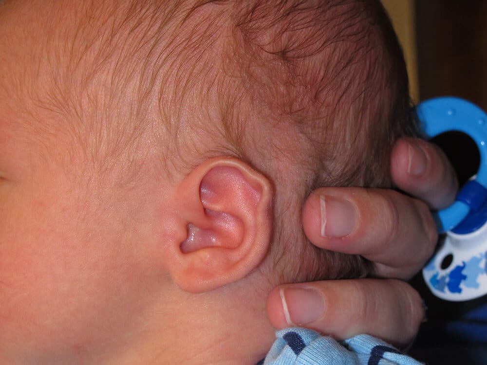 Case--7712 | Before EarWell™