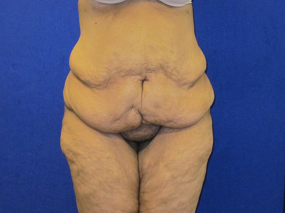 Case--7758 | Before Body