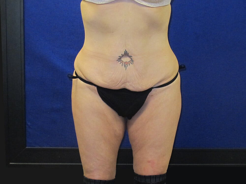 Case--1270 | Before Thigh Lift