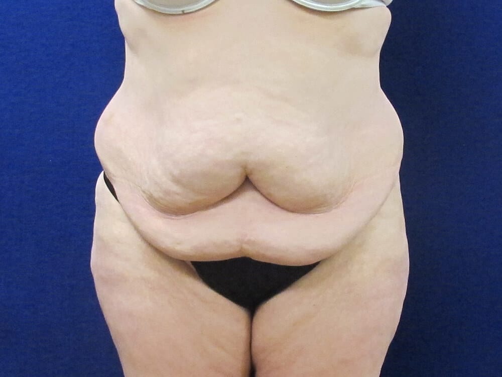 Case--7369 | Before Tummy Tuck