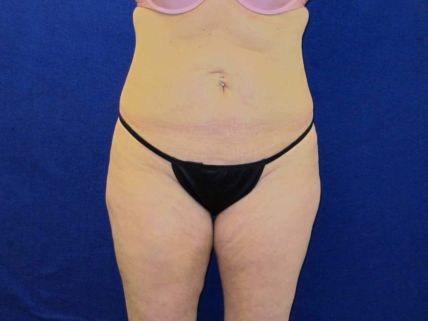Case--4293 | Before Tummy Tuck