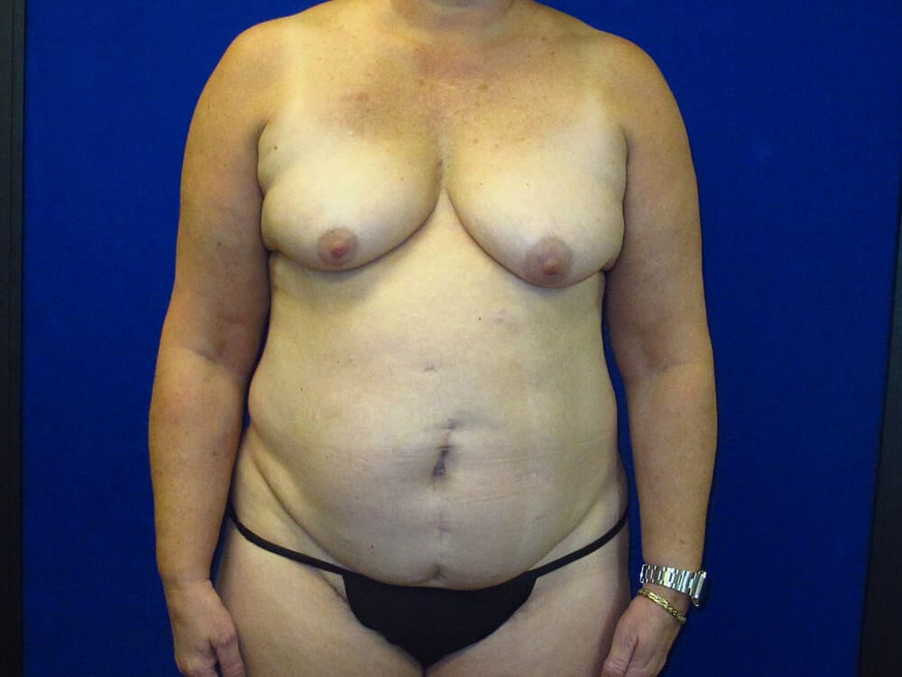 Case--9802 | Before Tummy Tuck